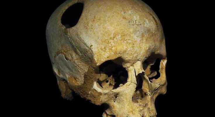 Trapanazione del cranio sul teschio di una donna del Neolitico. Il fatto che l'osso mostra segni di crescita lungo il perimetro del foro suggerirebbe che il paziente sia sopravvissuto all'intervento per qualche tempo.